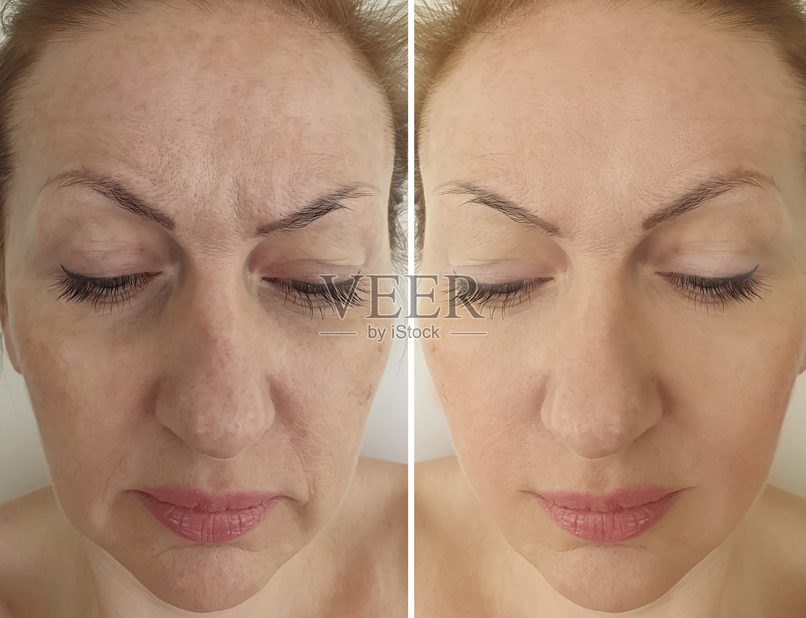 女人脸部皱纹治疗前后，拼贴照片摄影图片