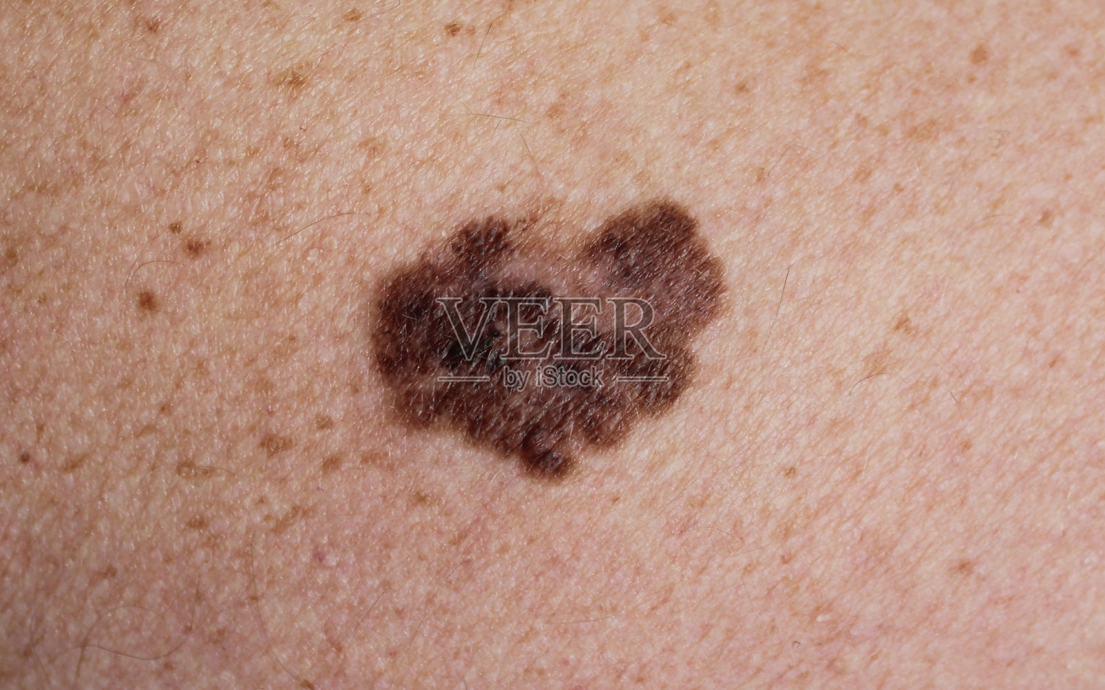 黑色素瘤——皮肤上的恶性肿瘤照片摄影图片