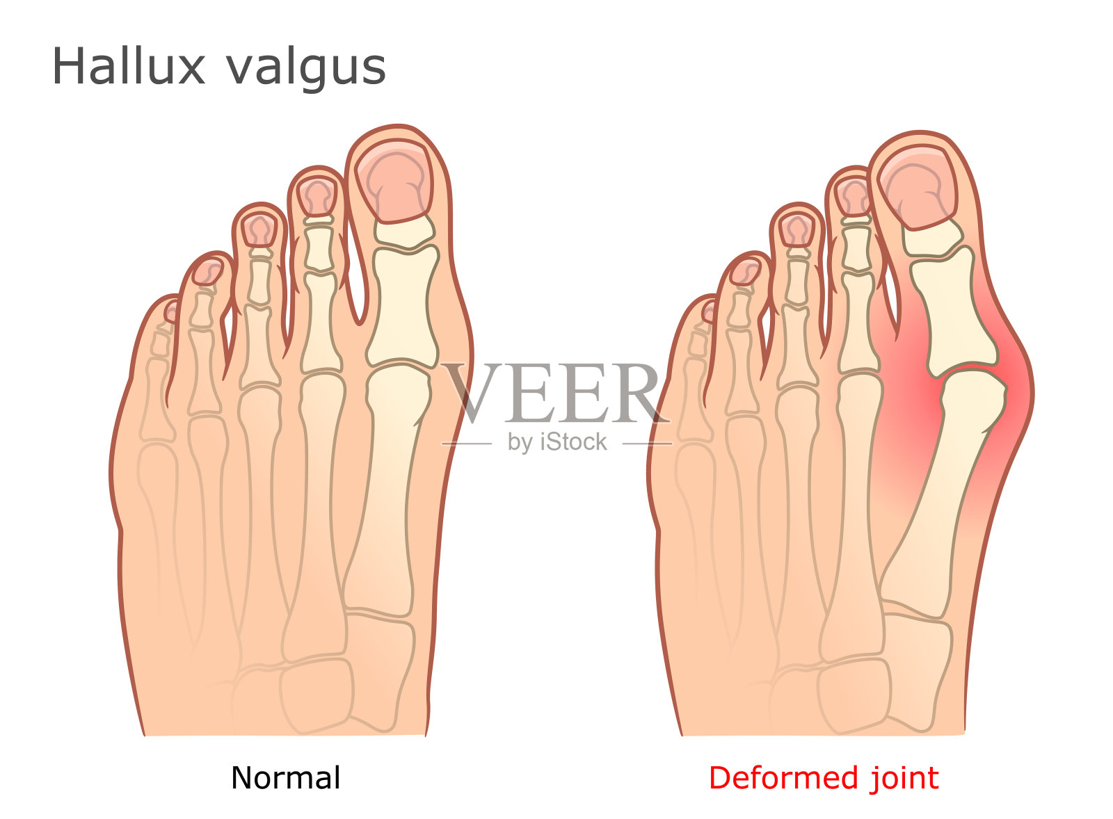 拇指外翻插图插画图片素材