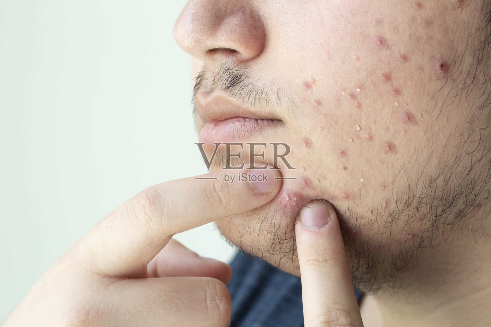 年轻人挤青春痘，男士护肤理念照片摄影图片