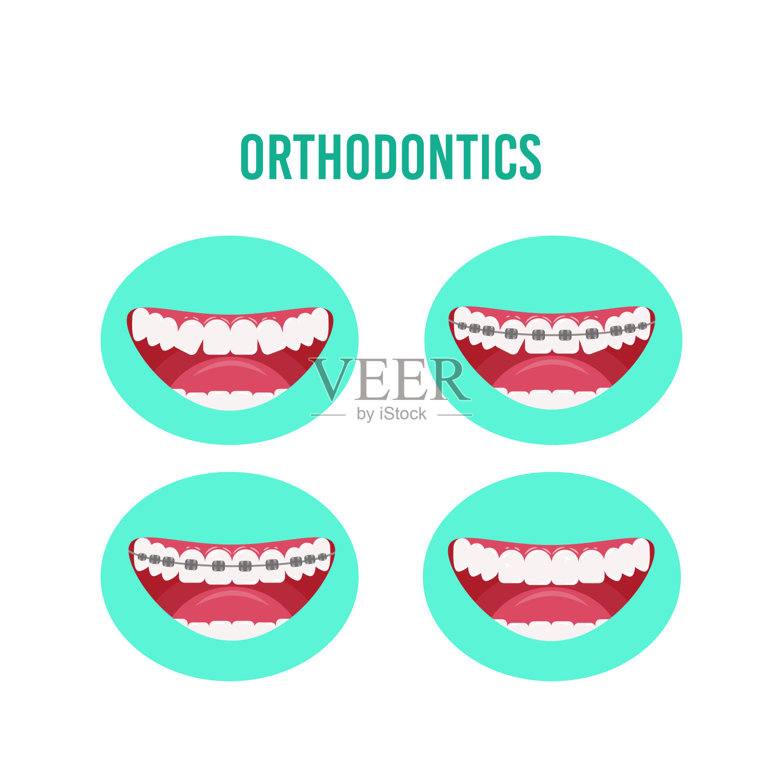 用牙套矫正牙齿，矫正过程的各个阶段。矢量插图在一个平面风格孤立在白色背景插画图片素材