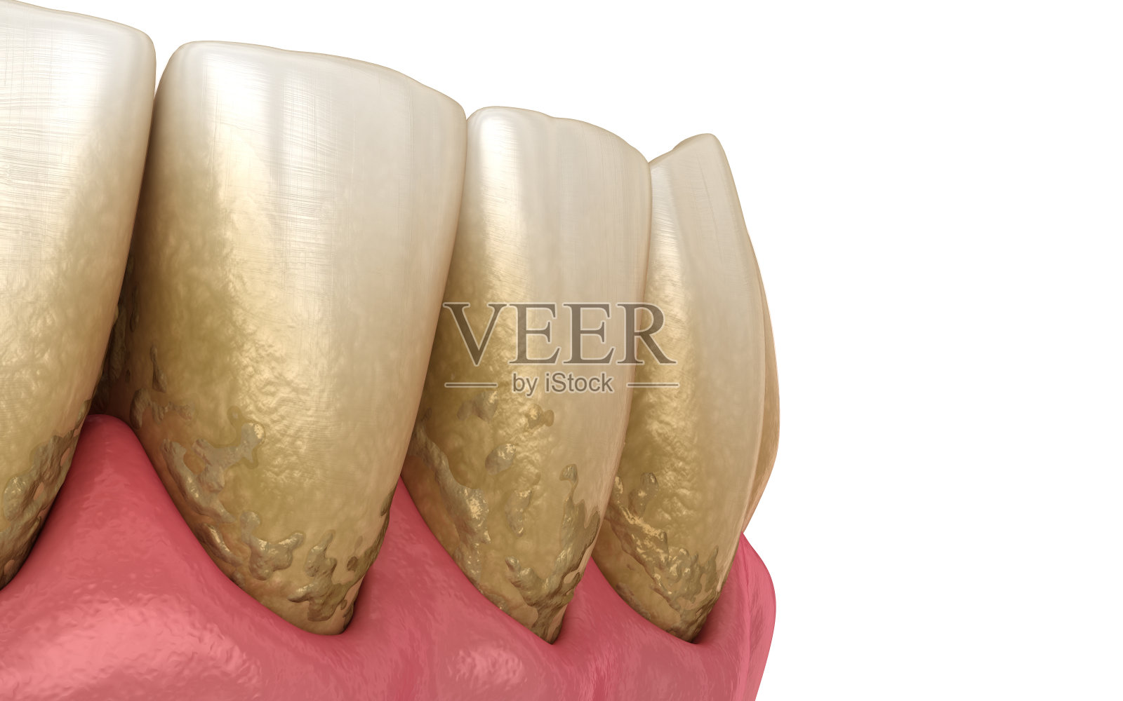 牙垢和牙菌斑，下颚。医学上精确的人类牙齿治疗的3D插图照片摄影图片