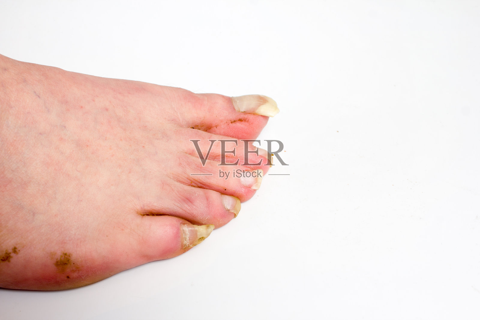 男人蓬乱的脚，长长的指甲。这个概念本身并不遵循。照片摄影图片