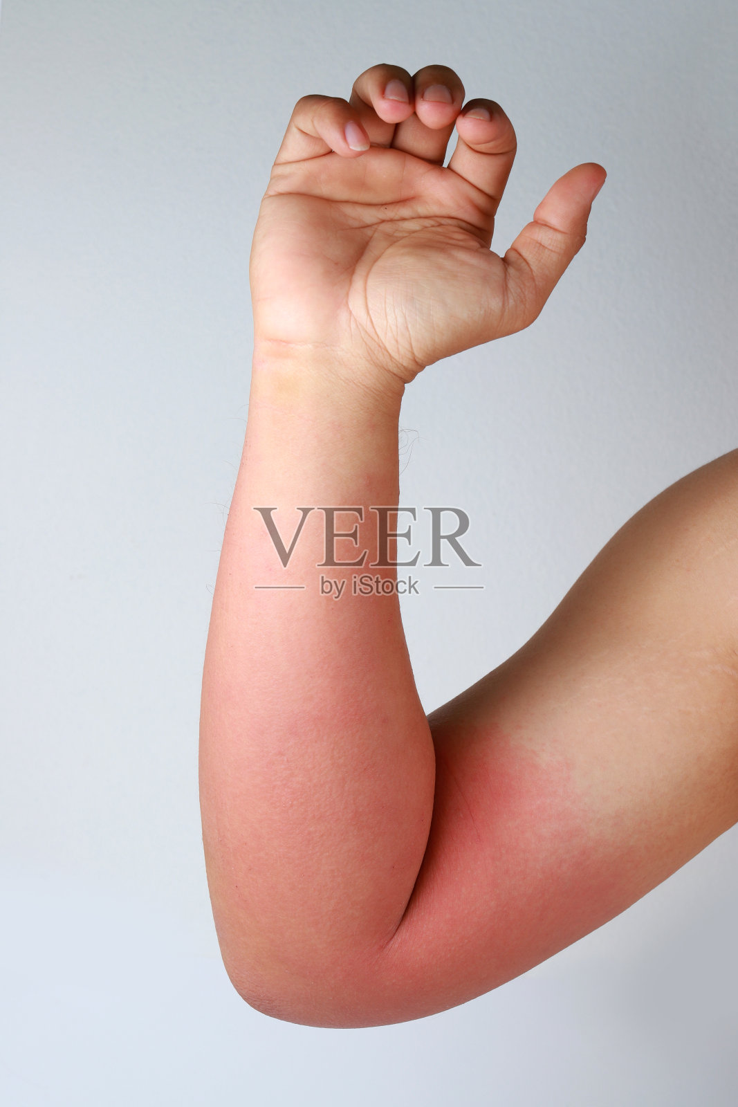 湿疹过敏皮肤，皮肤病。照片摄影图片