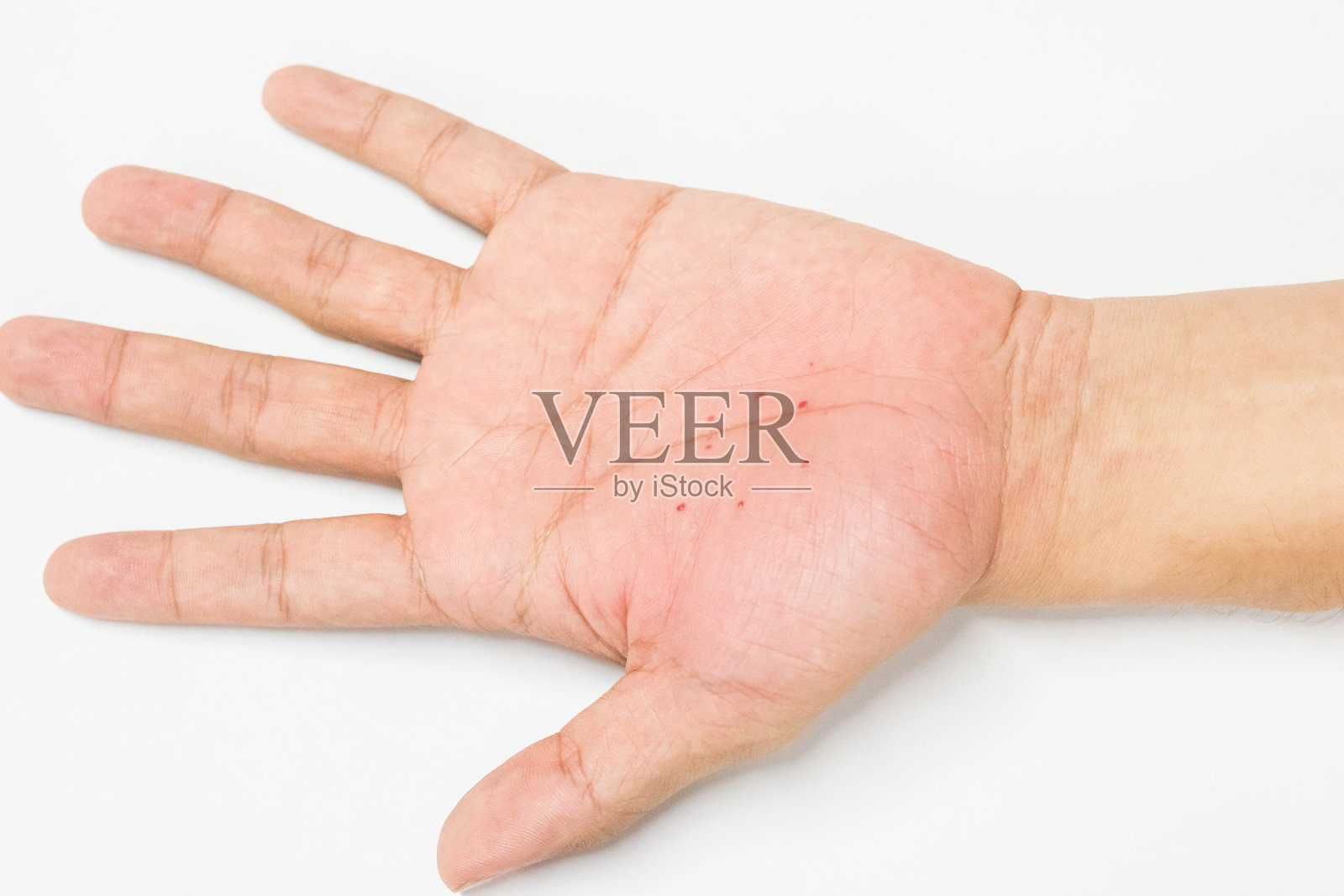 手部特应性皮炎(AD)，又称特应性湿疹照片摄影图片