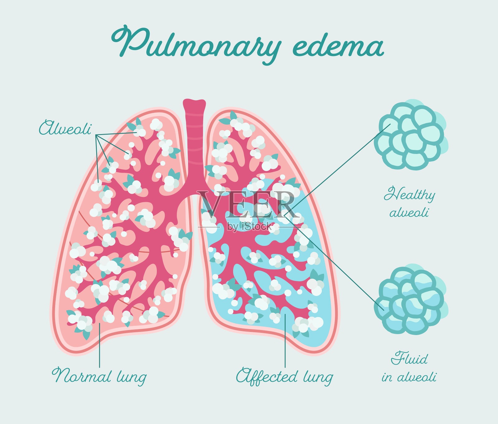 肺水肿，肺水肿。肺泡中液体-载体解剖结构。比较健肺和充液肺插画图片素材