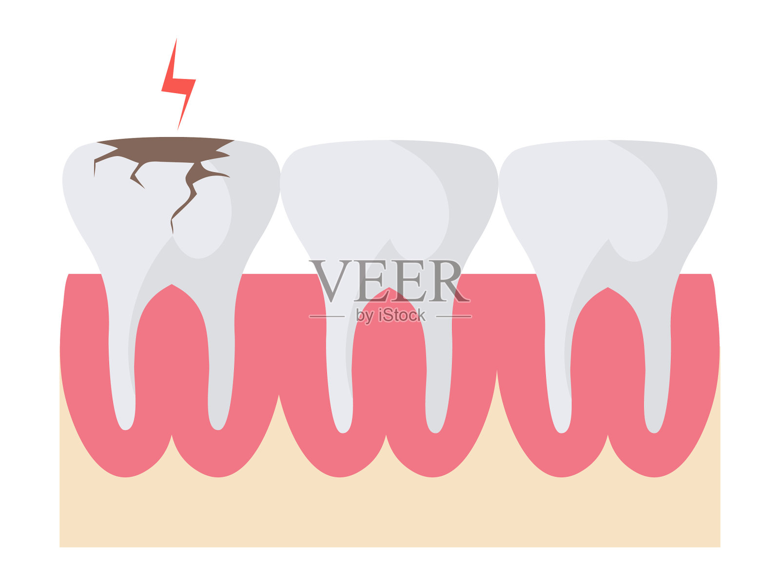 牙齿腐烂在口腔示意图上的白色卡通设计元素图片