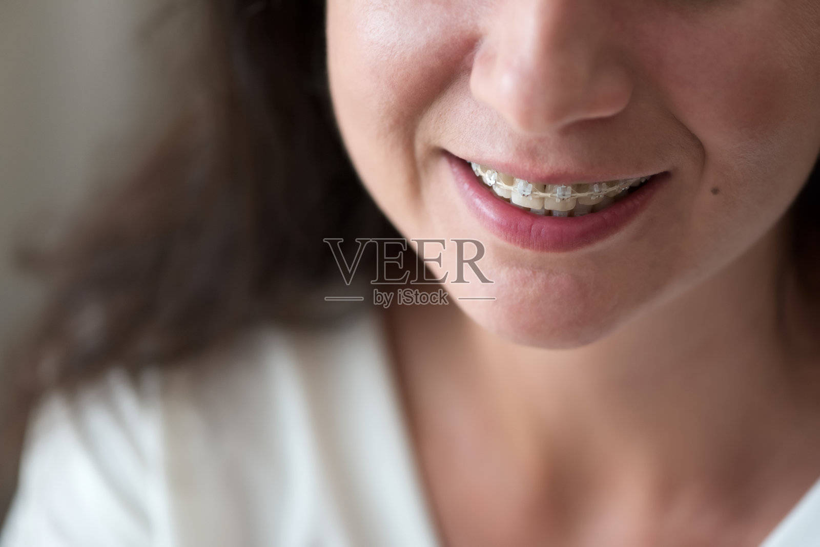 特写女人微笑的牙套。口腔正畸治疗。身体积极的。软焦点照片摄影图片