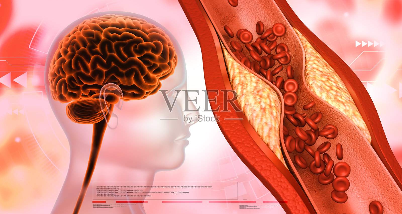 血凝块。脑卒中照片摄影图片