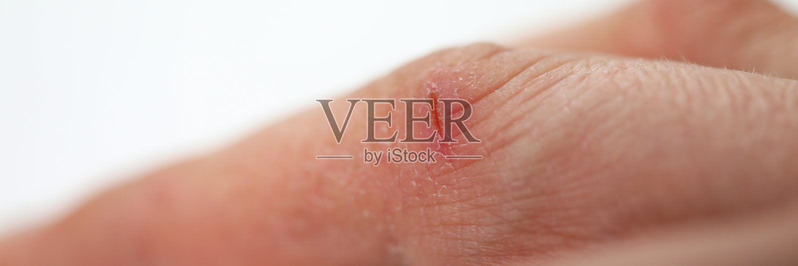 特写手指上的小伤口，手部皮肤干燥照片摄影图片