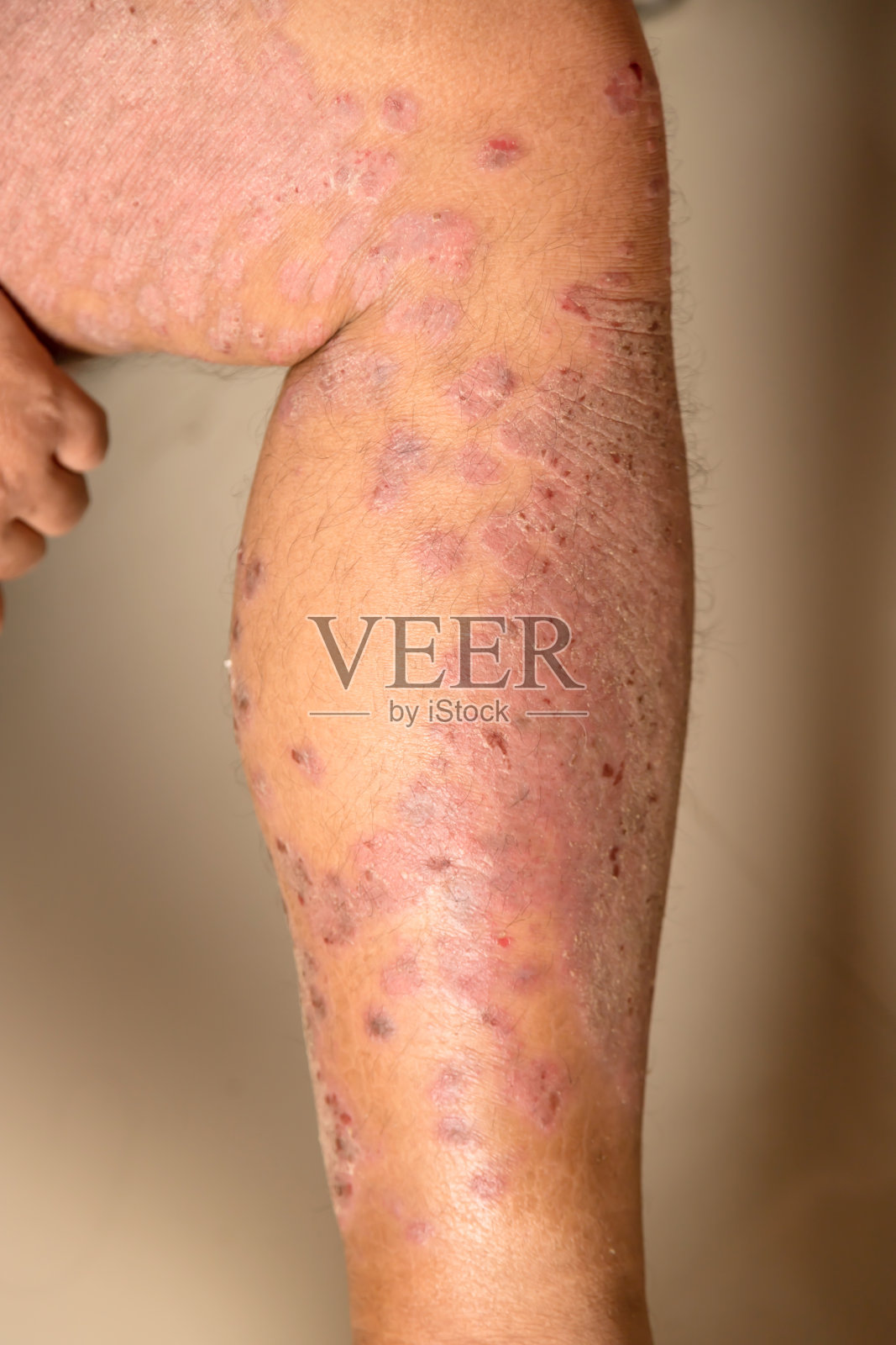 由淋巴异常引起的疾病。牛皮癣是一种皮肤病。照片摄影图片