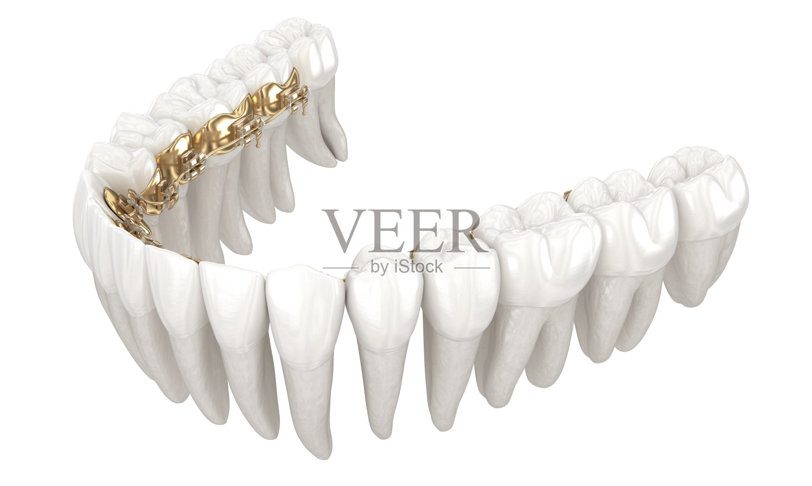 舌牙套系统。金牙套的3D插图概念照片摄影图片