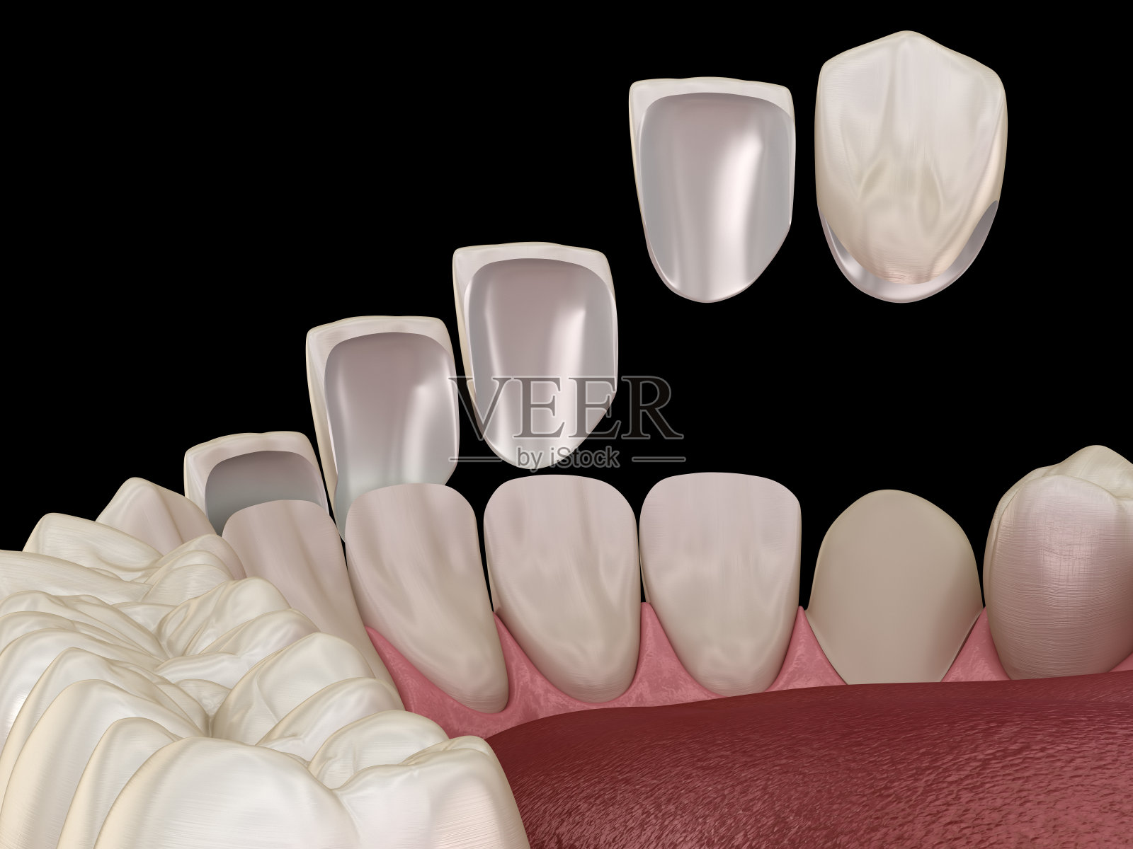 中切牙和侧切牙贴面安装程序。医学上准确的牙齿3D插图照片摄影图片