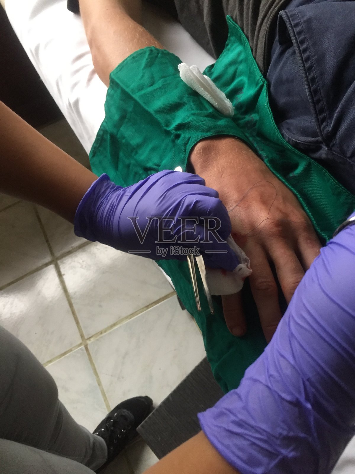 有一个大伤口正在接受缝针的手照片摄影图片