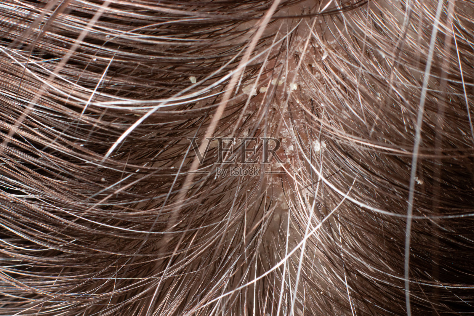 人的头发有头皮屑的微距照片。头部伤口及瘙痒，头发护理，脂溢性治疗。干性皮脂肿——头皮发痒和剥落照片摄影图片