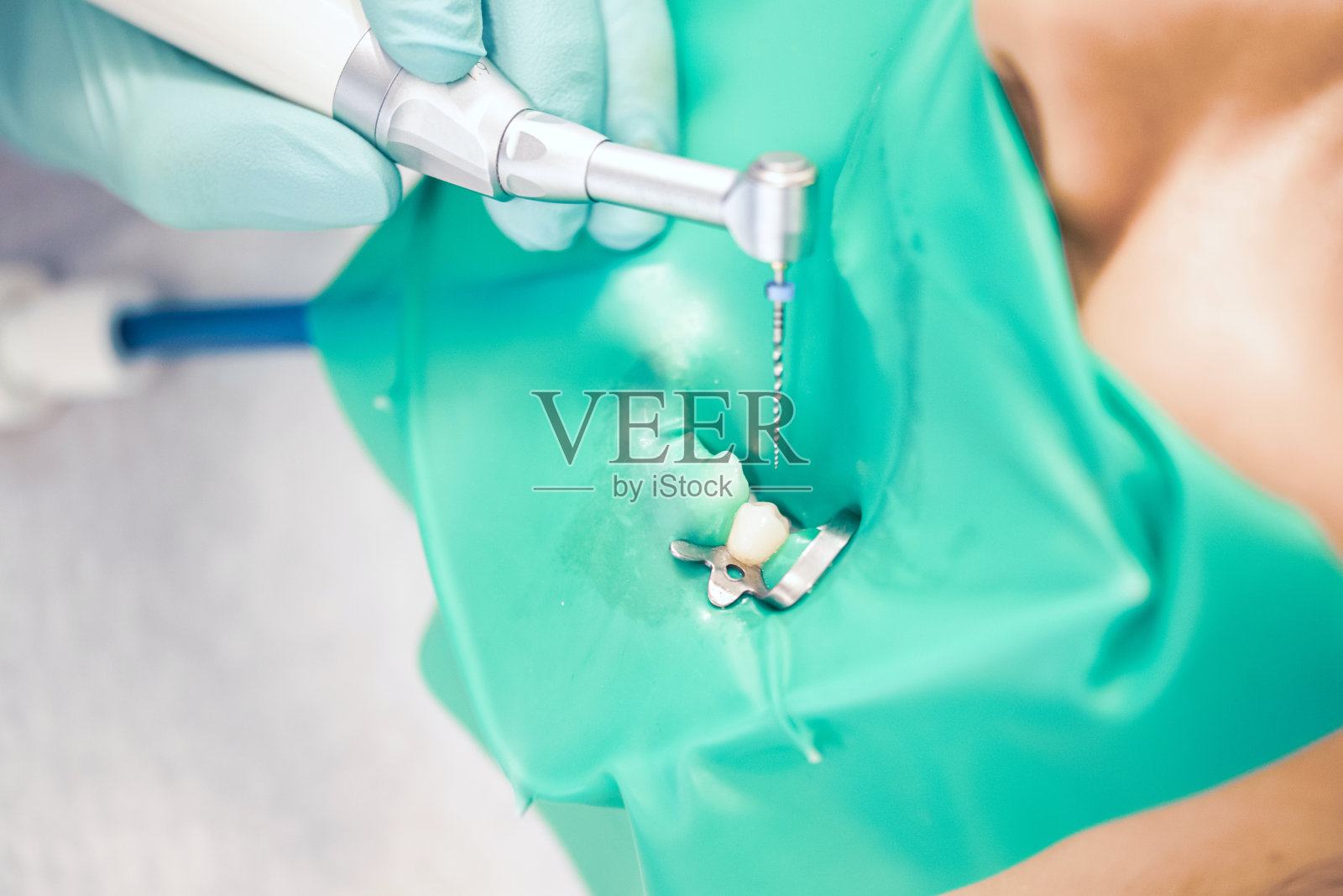 在底部臼齿的牙科管道的治疗使用一个尖定位文件，一颗牙齿与夹附在它与一个围堤。照片摄影图片