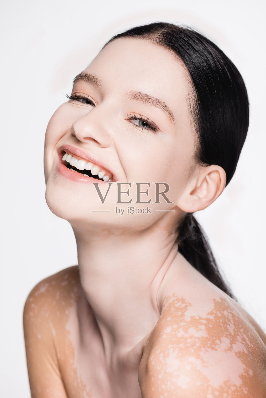 微笑年轻美丽的女人与白癜风孤立在白色照片摄影图片