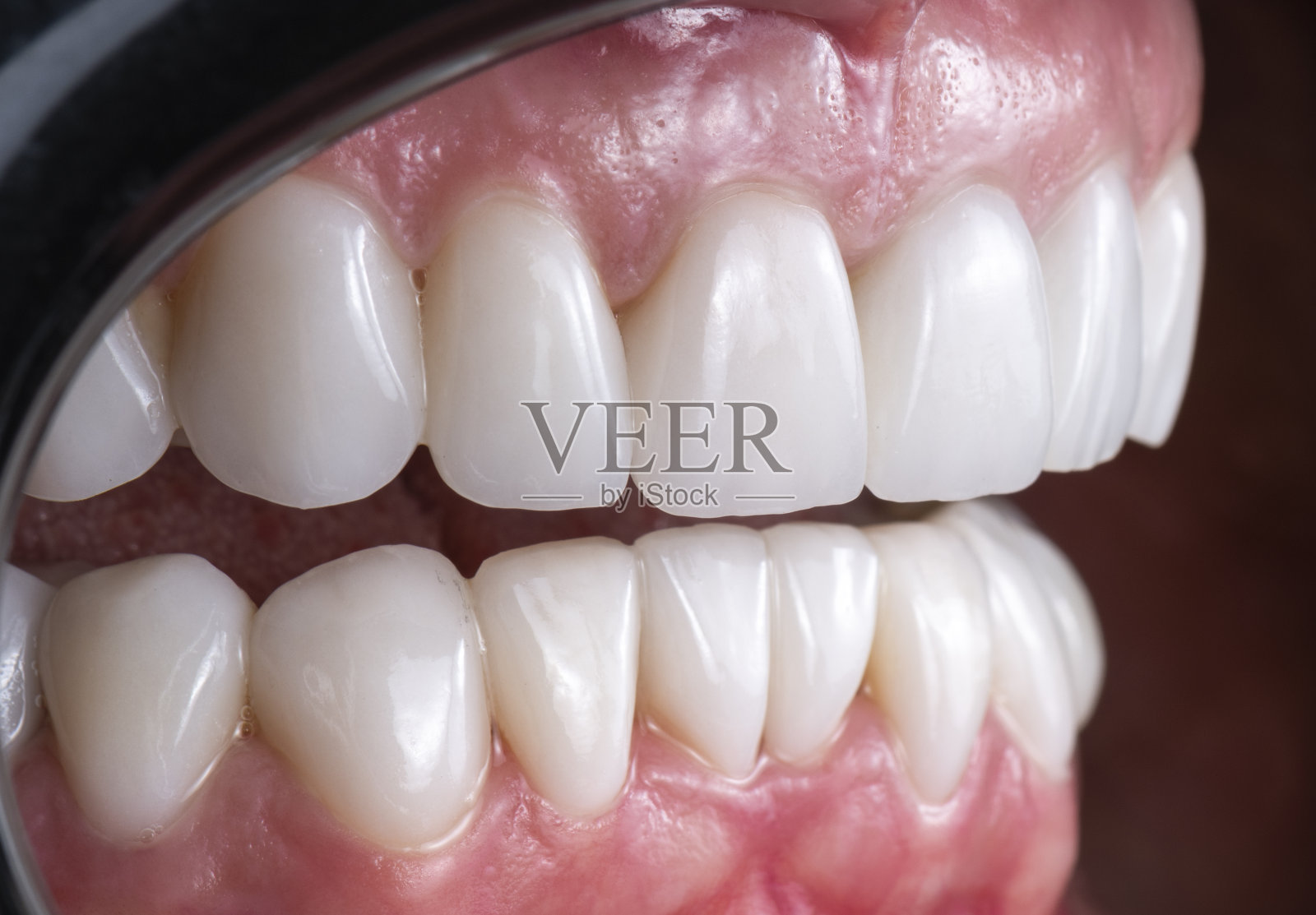 20台emax压瓷贴面照片摄影图片