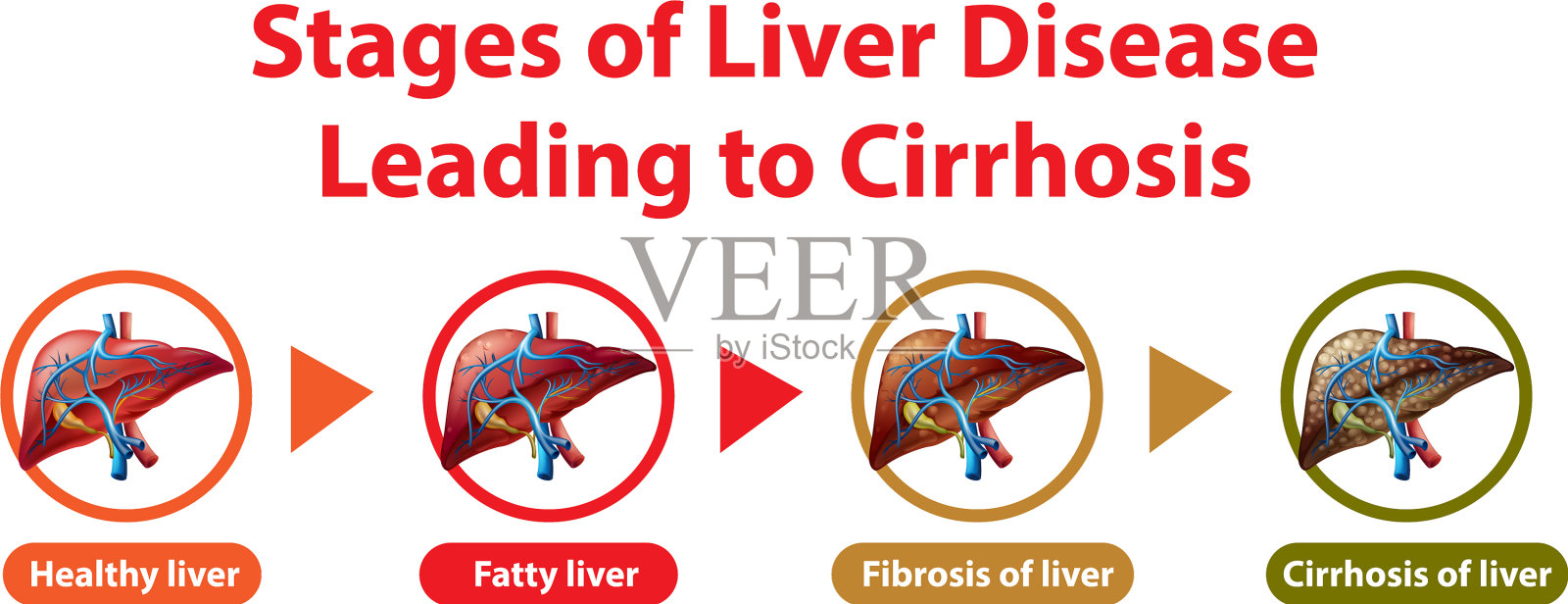 导致肝硬化的肝病分期插画图片素材