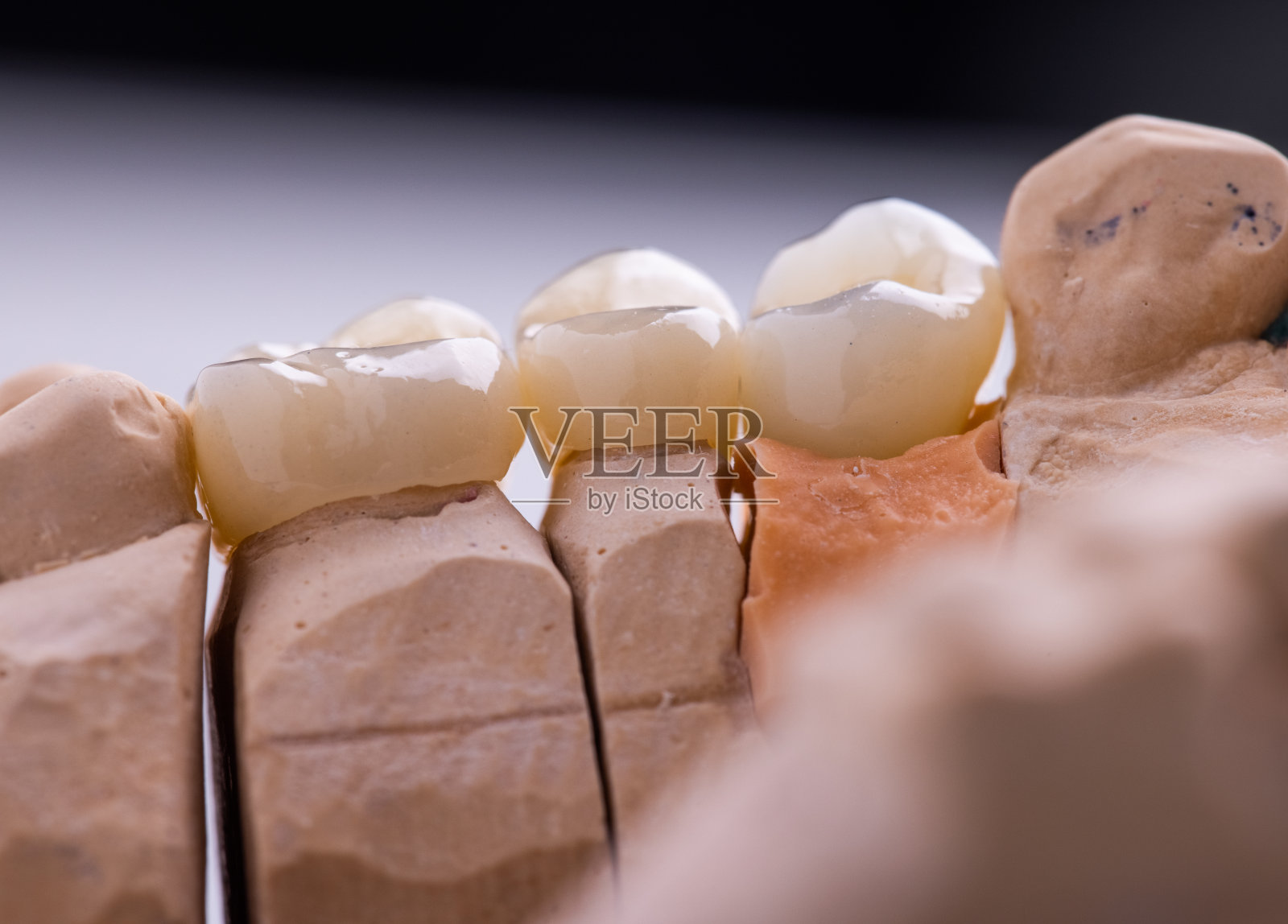 氧化锆冠植入照片摄影图片