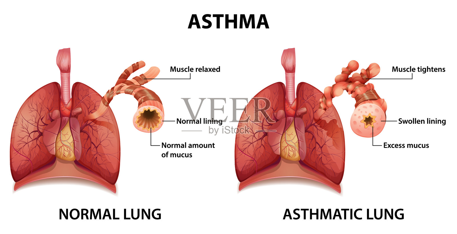 健康肺和哮喘肺的比较插画图片素材