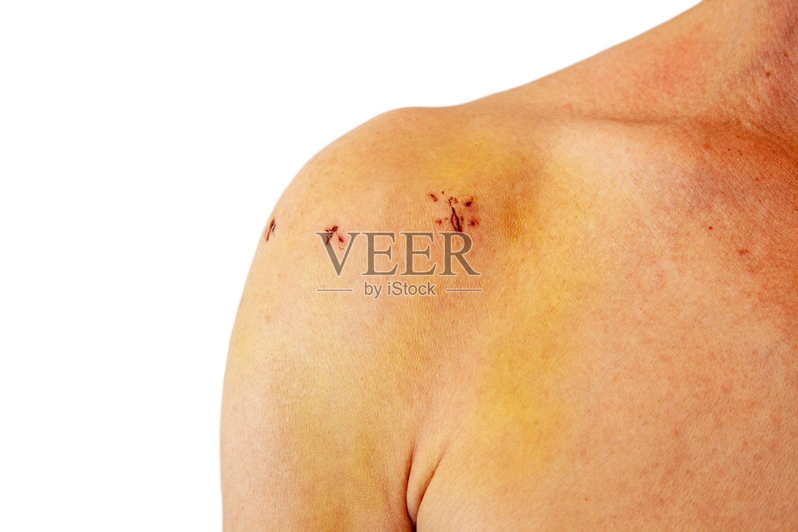 男性肩关节镜手术后有疤痕。术后慢性二头肌长肌腱脱位。照片摄影图片