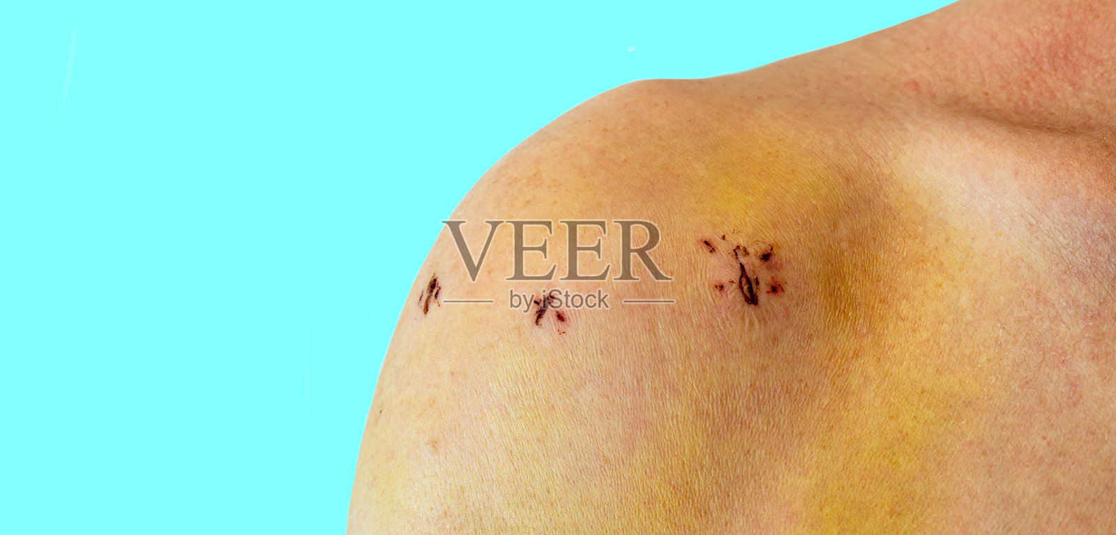 男性肩关节镜手术后有疤痕。术后慢性二头肌长肌腱脱位。照片摄影图片