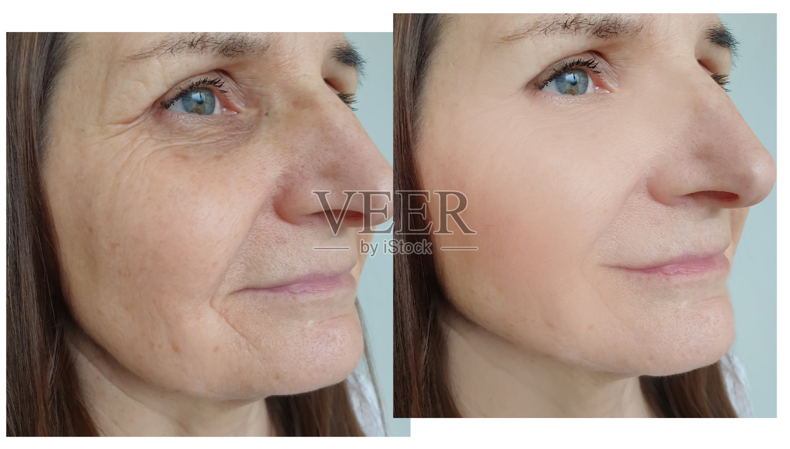 女性面部皱纹治疗前后照片摄影图片