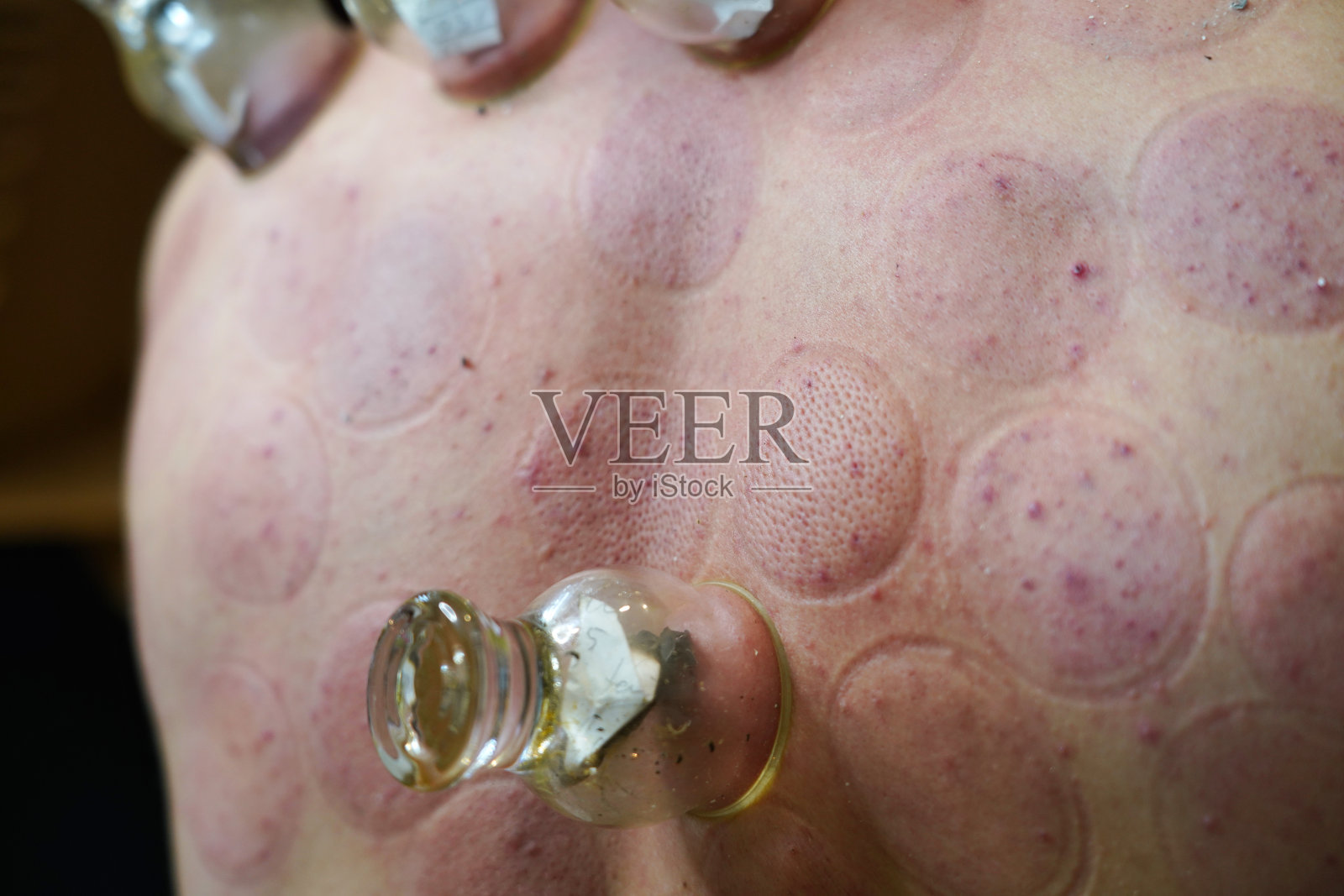 治愈放血，hijama或静脉切开。哈贾姆大师在一个年轻人身上进行拔火罐治疗。伊斯兰医学照片摄影图片