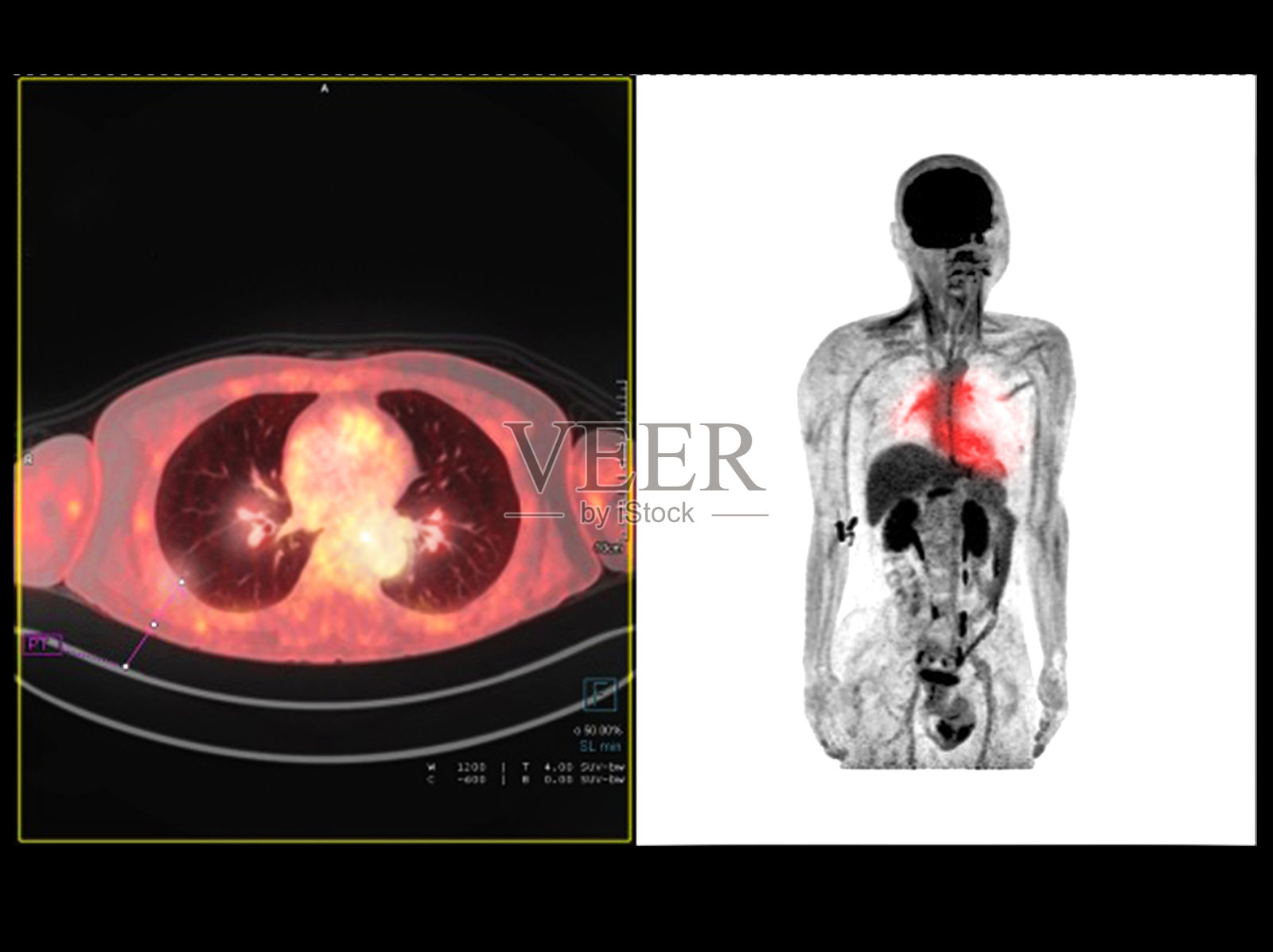 胸部或胸部PET扫描图像比较轴向，冠状，检测肺癌复发照片摄影图片