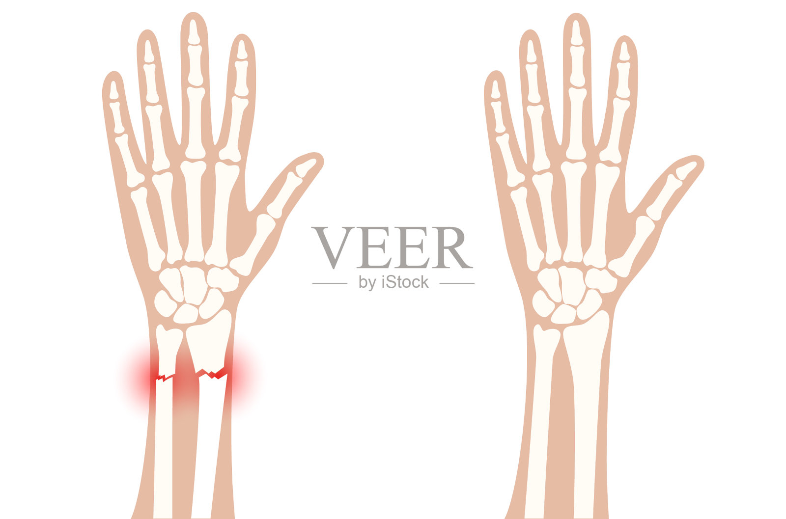 骨折x射线概念插画图片素材