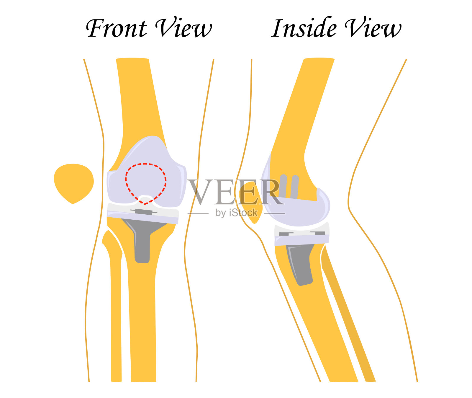 膝盖替换。联合假肢。膝盖endoprosthesis。矢量插图。平面设计插画图片素材