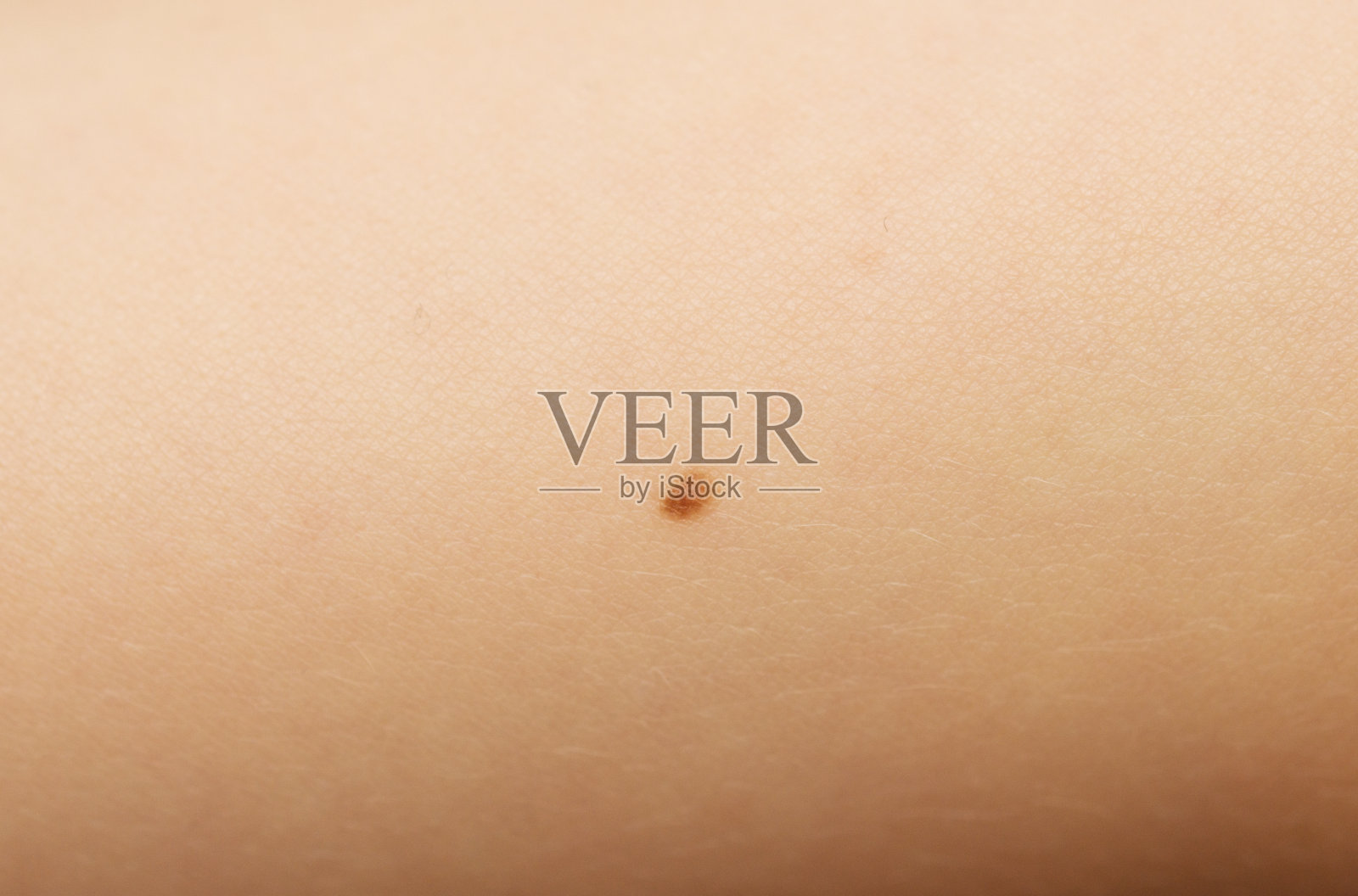 胎记在皮肤照片摄影图片