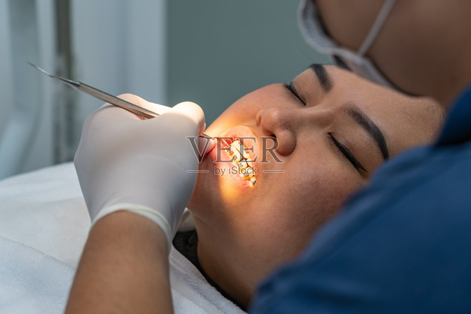 戴着牙托槽的妇女在牙齿矫正诊所接受牙科检查照片摄影图片