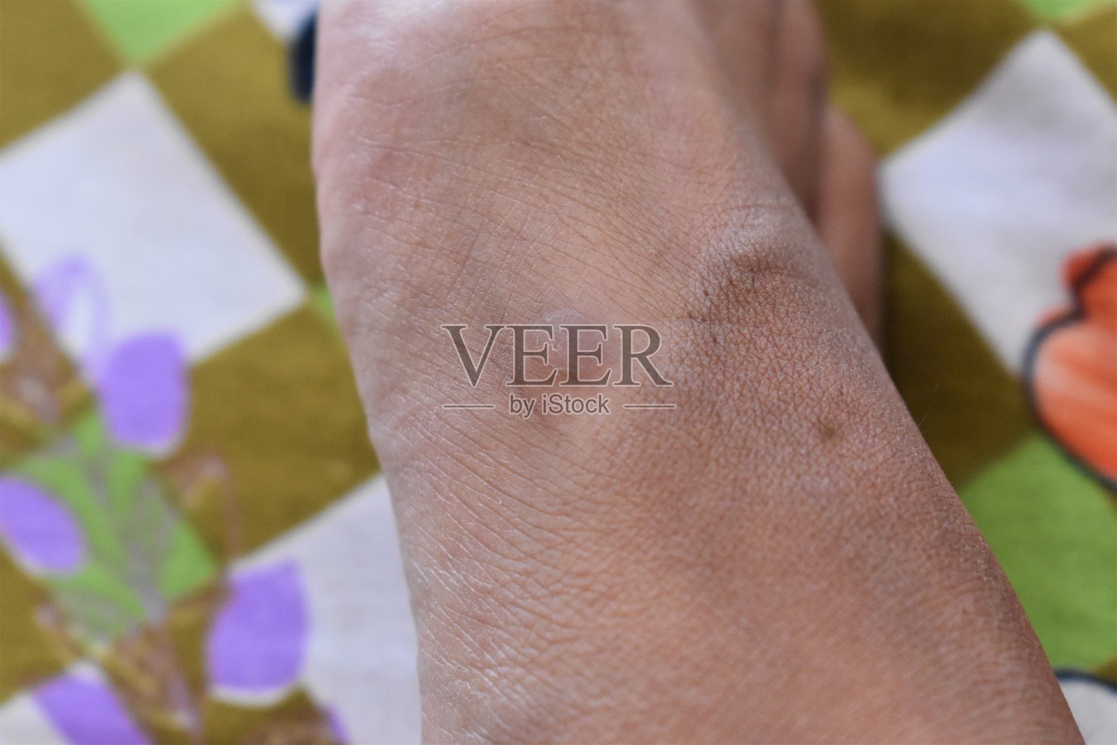 脚上的伤口或溃疡照片摄影图片