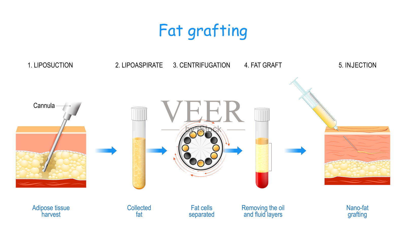 脂肪移植插画图片素材