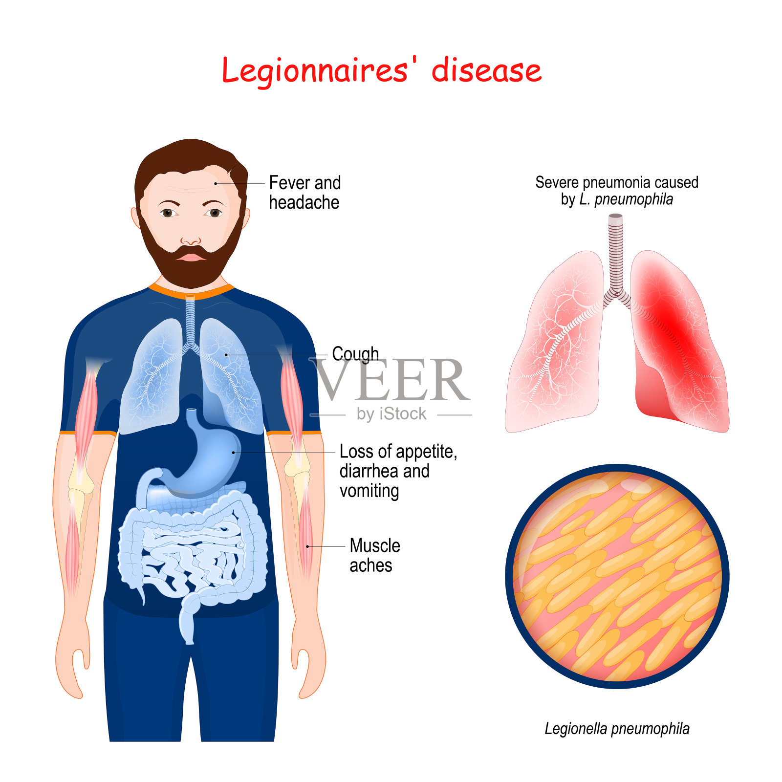 军团病。非典型性肺炎插画图片素材