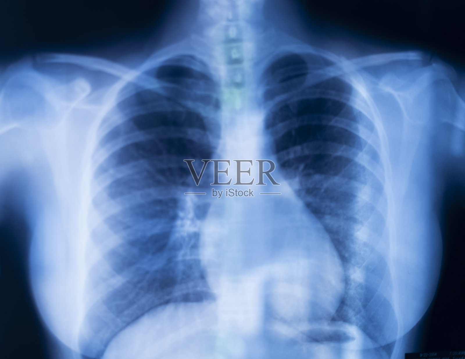 肺肋骨x线扫描结果。照片摄影图片