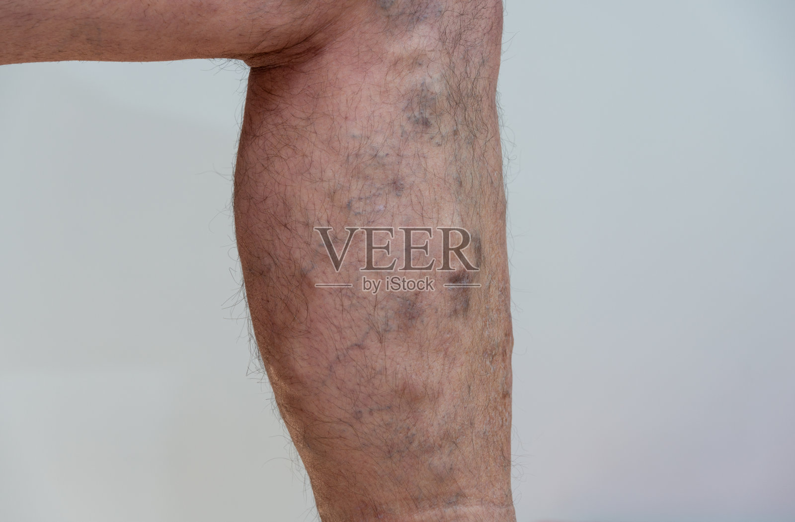 白色背景下老年男性腿部静脉曲张。照片摄影图片