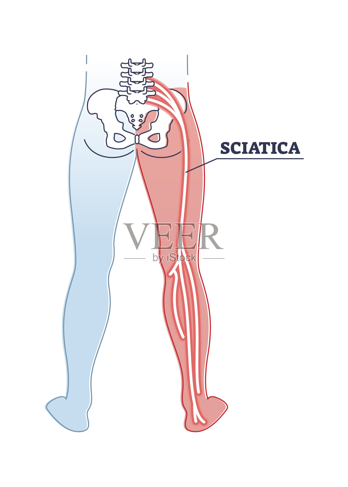 坐骨神经痛或神经无力为下肢腰神经根病的轮廓图插画图片素材