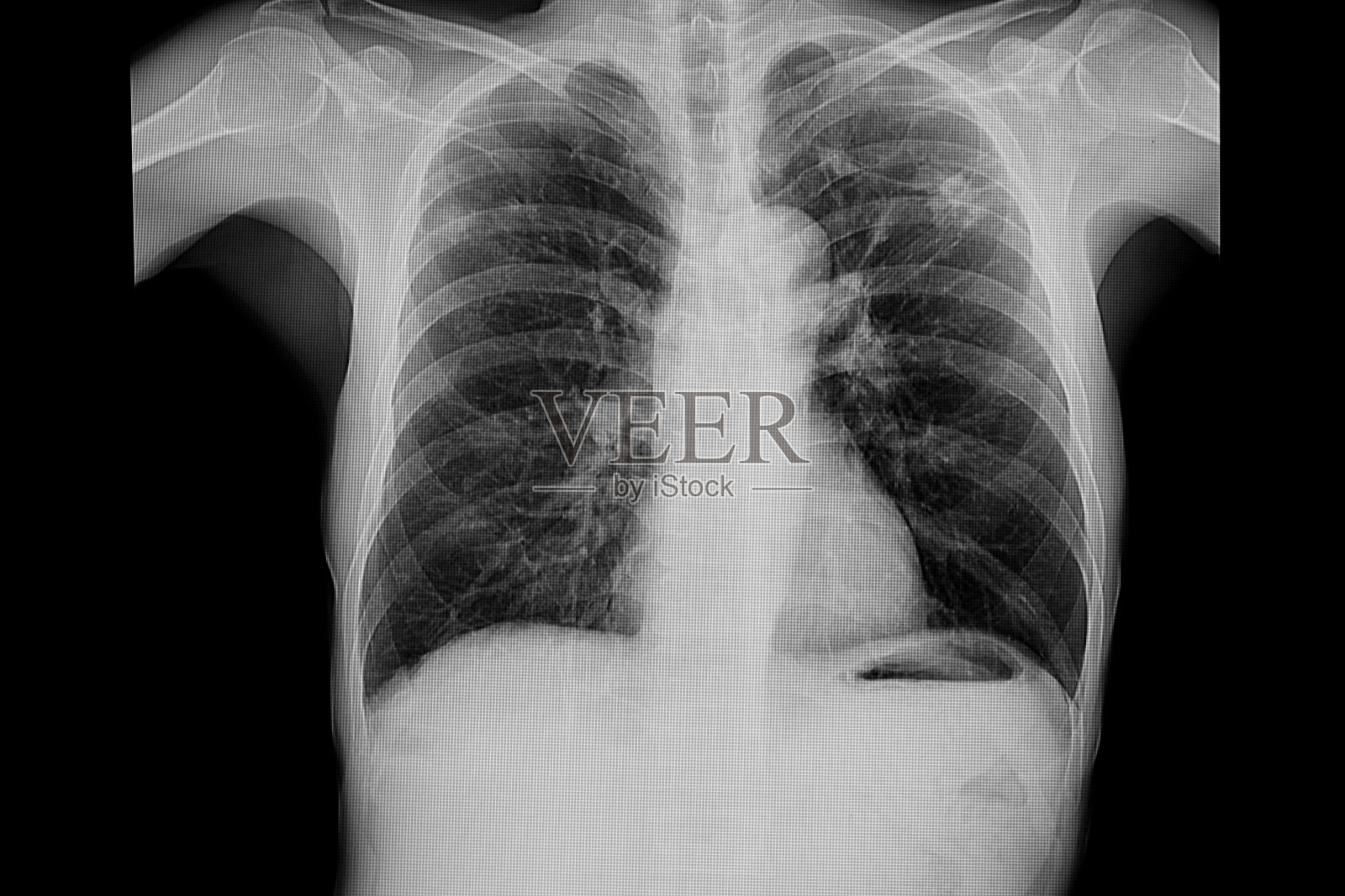肺结核病人的胸部x光片。照片摄影图片
