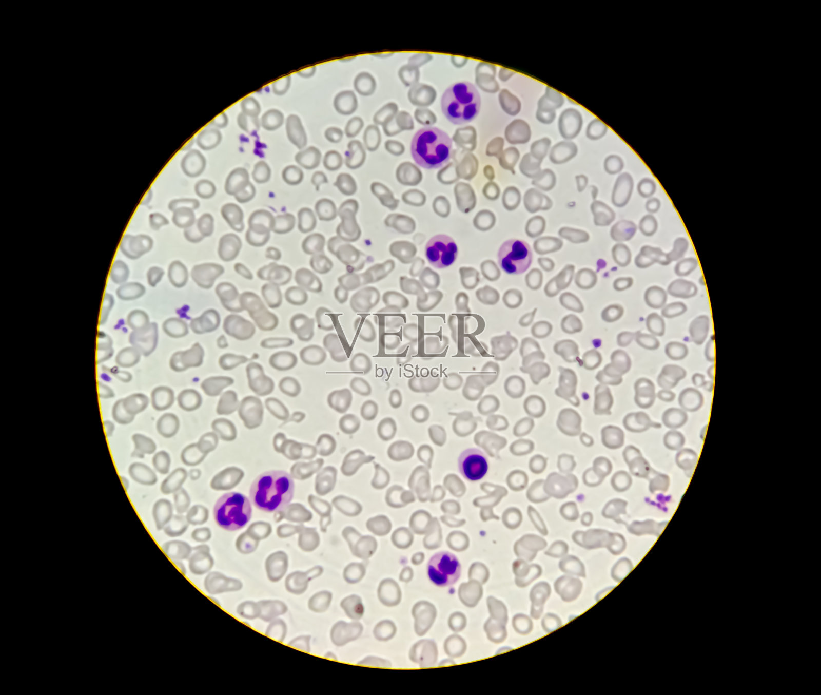 中性白细胞增多照片摄影图片