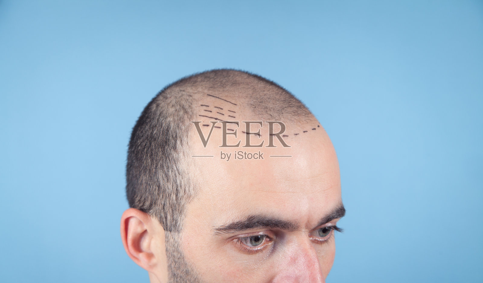 白种人的秃头。之前的头发移植照片摄影图片