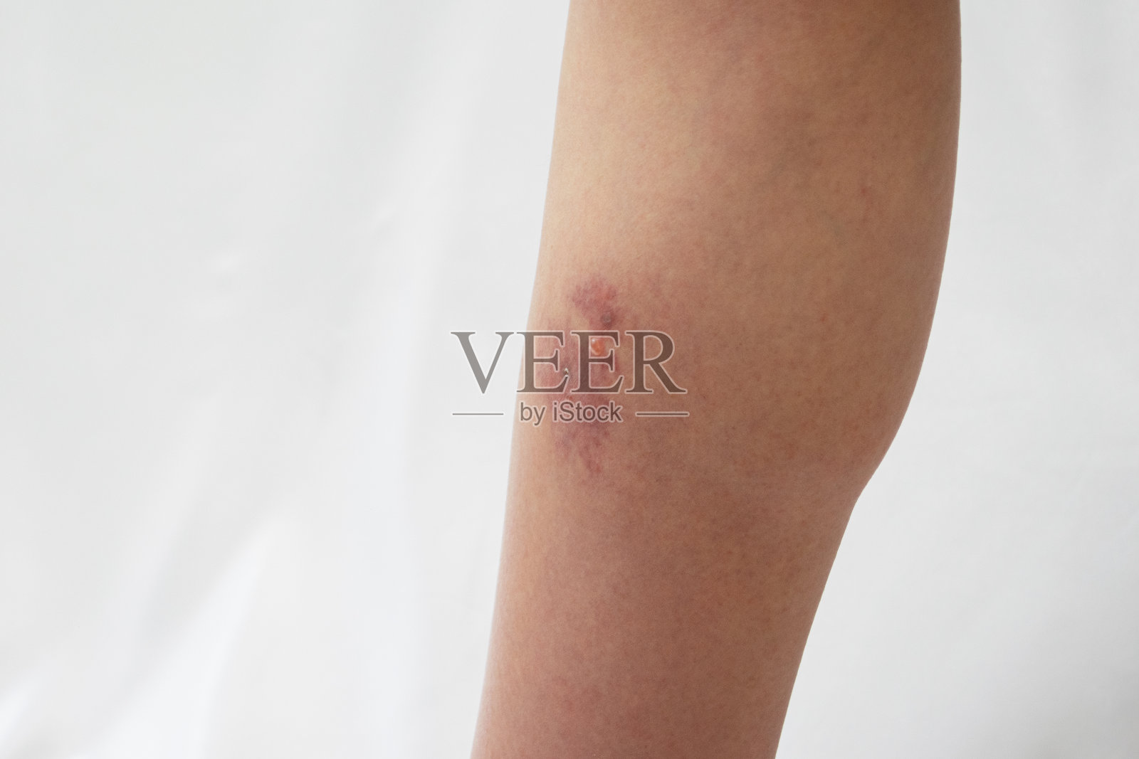 一条有细菌性蜂窝织炎症状的腿照片摄影图片