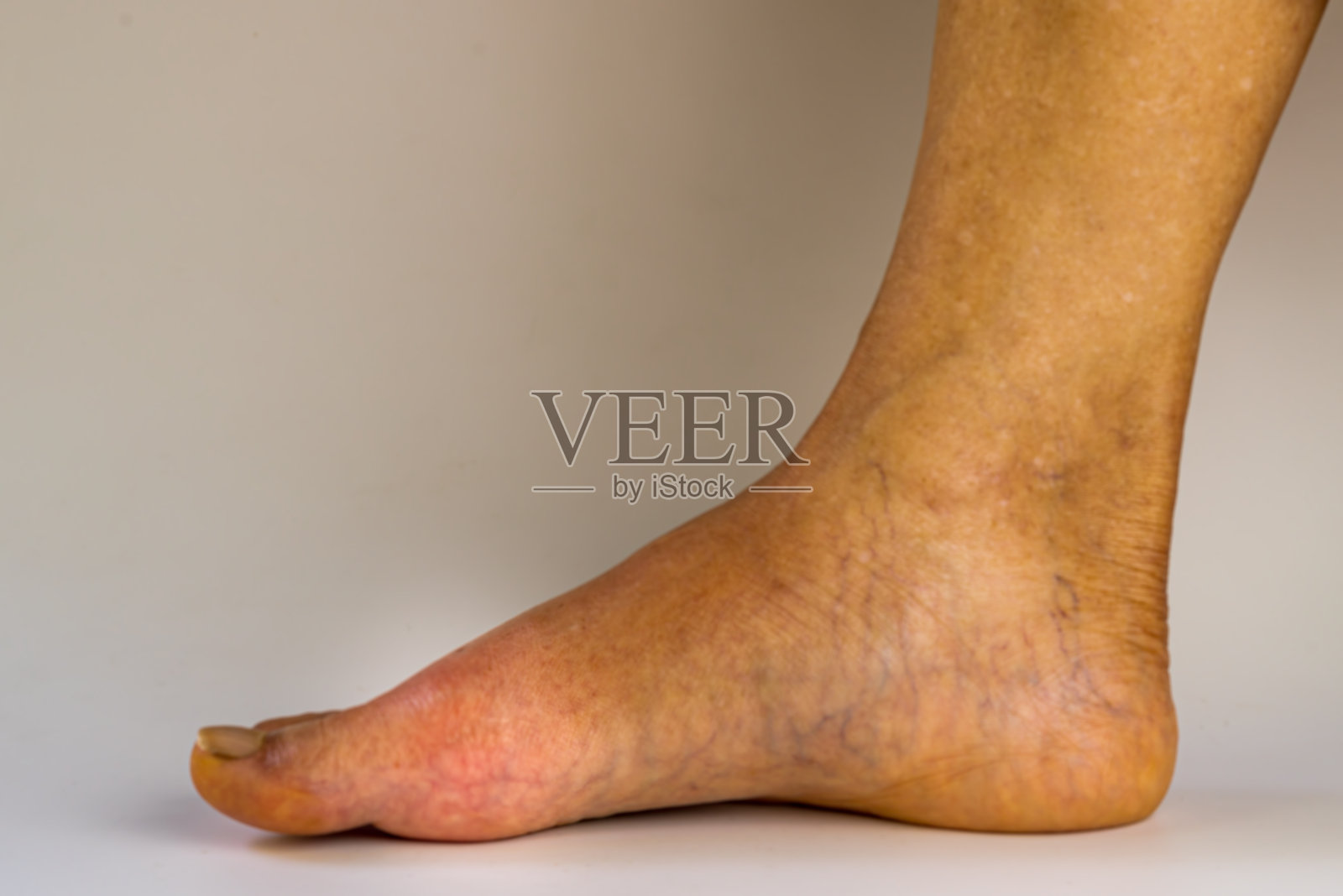 右老人足观，急性关节炎痛风引起大脚趾关节痛、红、肿、痛。照片摄影图片