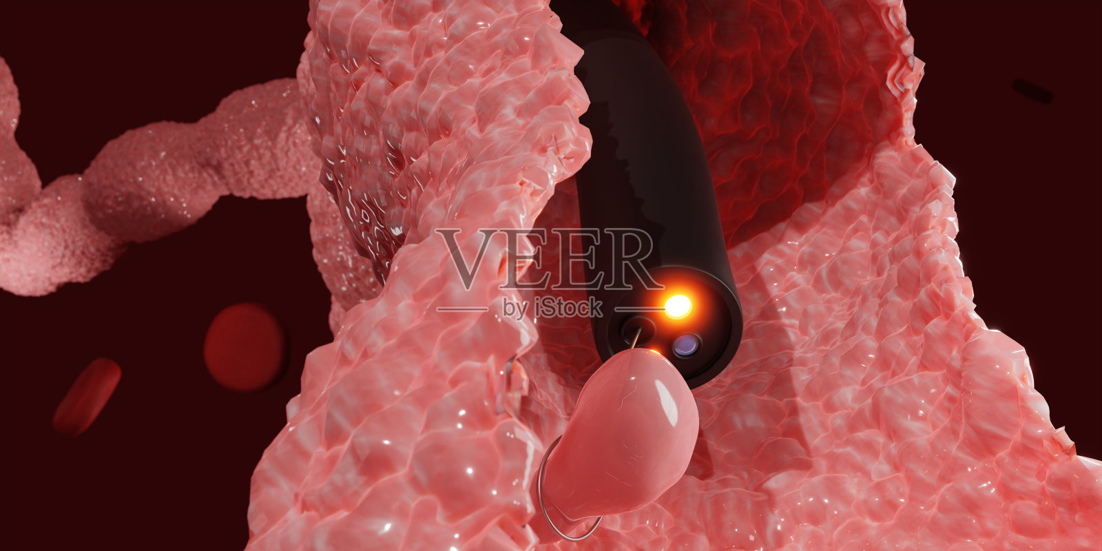 结肠息肉切除。结肠镜内窥镜用于结肠息肉的检查。3 d渲染。照片摄影图片