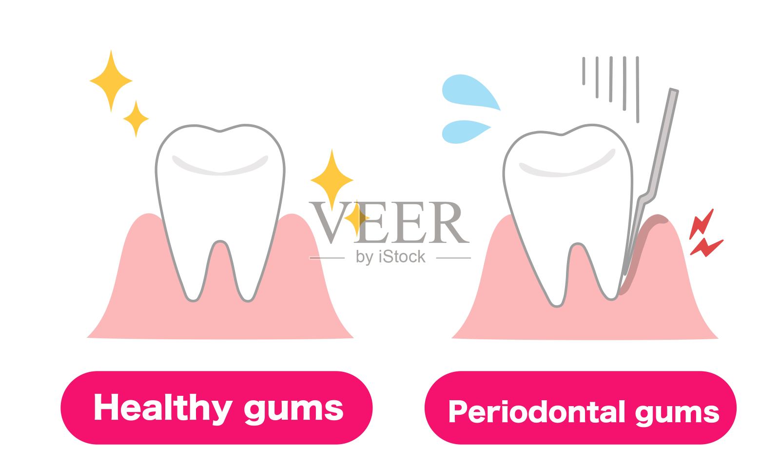健康牙龈和牙周病牙龈的医学插图插画图片素材