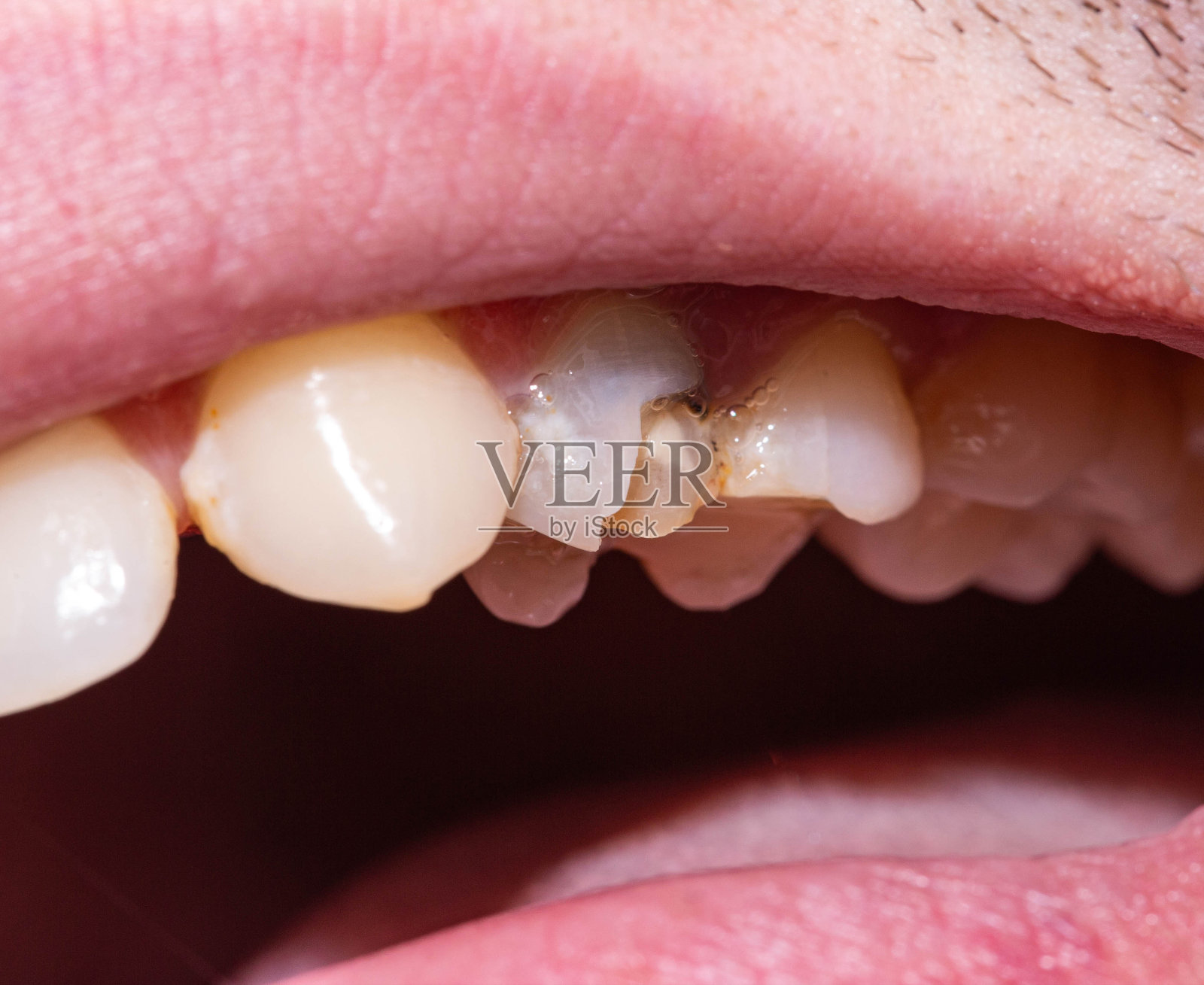 一颗黑色的死牙，其中有一块牙釉质脱落，牙齿碎片。现代牙科修复的概念，宏观照片摄影图片