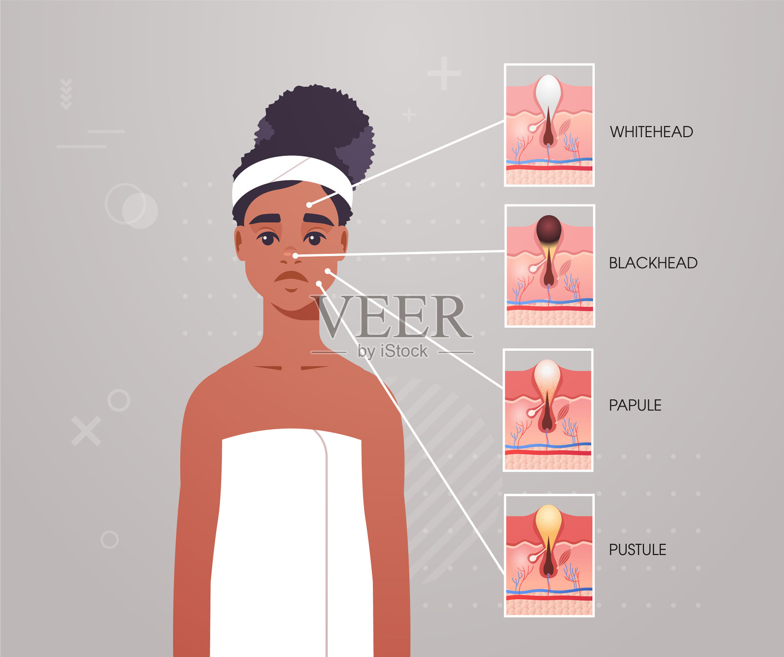 面部皮肤不同类型的痤疮、脓疱、丘疹插画图片素材