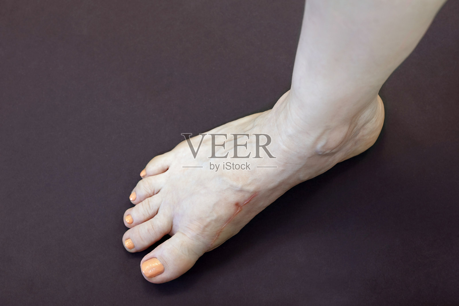 女性右腿外伤或手术后有瘢痕，鞋子紧致，大脚趾或第一跖趾关节畸形，拇外翻或拇外翻。照片摄影图片